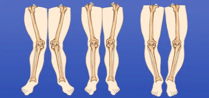 أعراض تقوس الساقين عند الاطفال