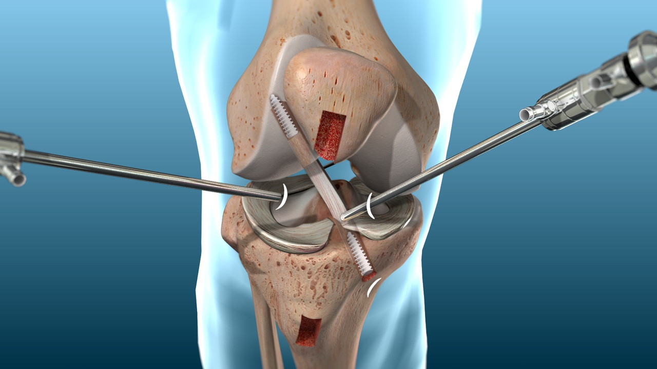 !The best doctor for ACL surgery in Egypt and the cost of this surgery