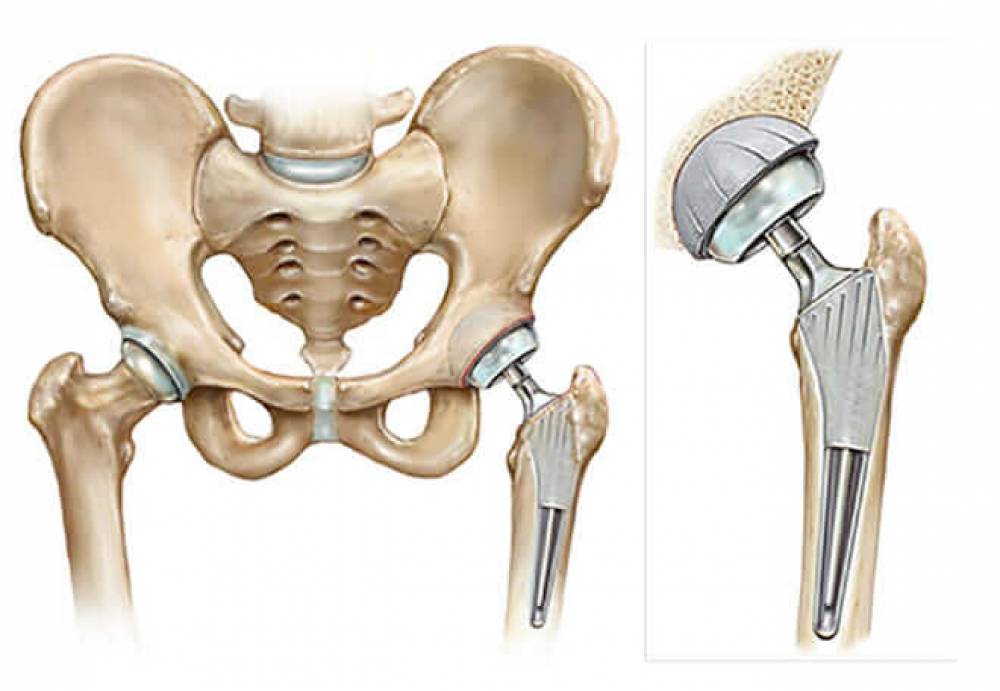 !Walking After Hip Joint Replacement Surgery and How This Surgery Is Performed