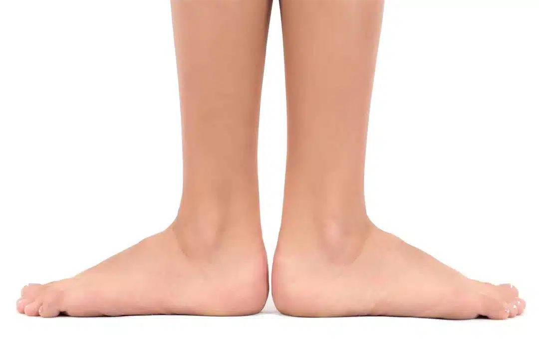 Types of flatfoot