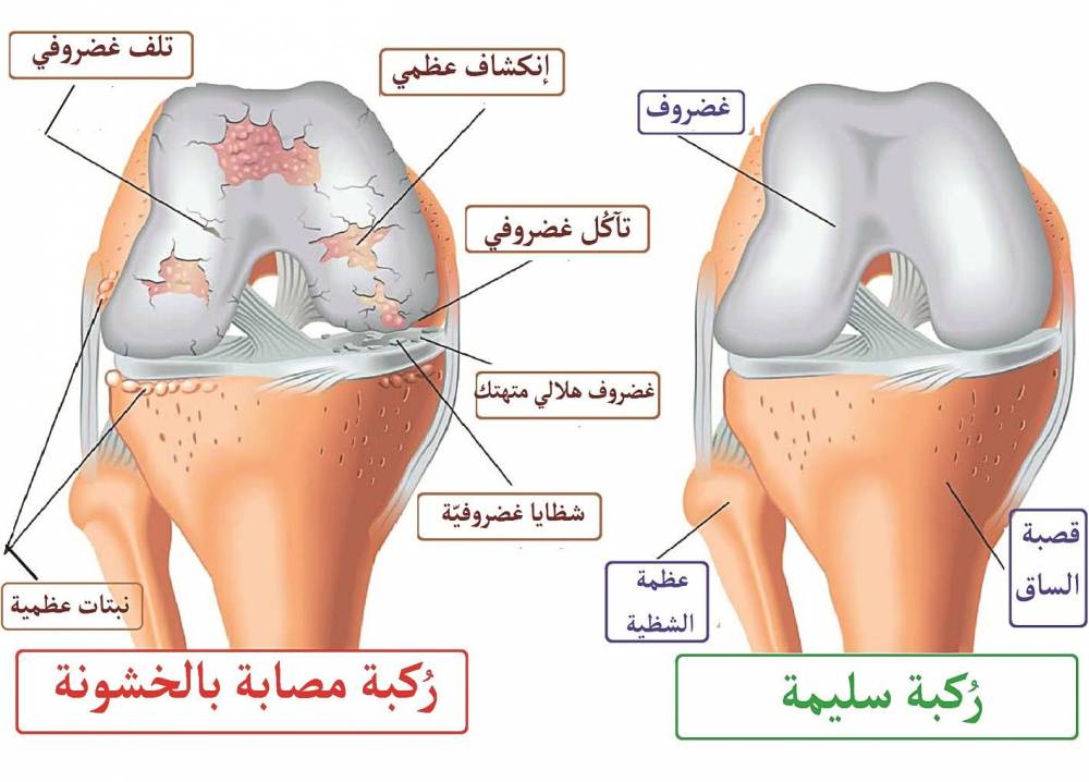 أسباب التهاب المفاصل