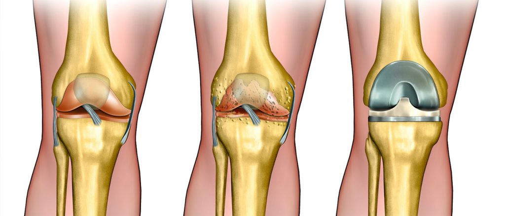 !Information about Knee Joint Replacement and Cases Requiring Surgery