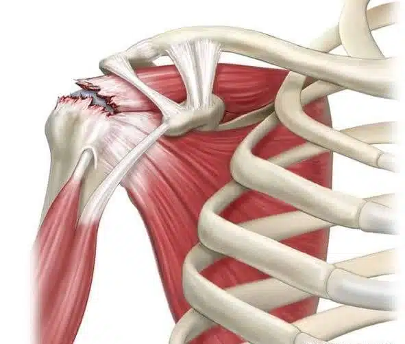 ما هي مدة الشفاء من عملية منظار الكتف؟