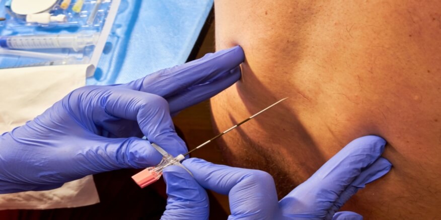 Cost of Cartilage Injections