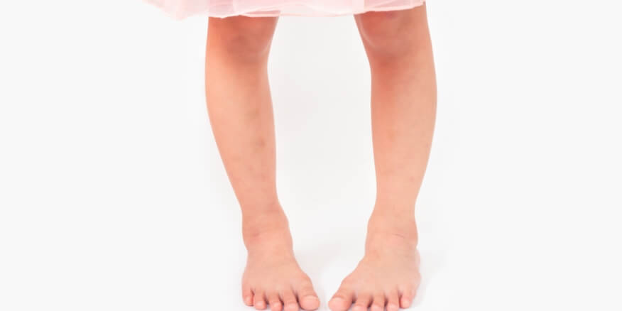 !Learn About the Treatment of Bowlegs in Children and Its Different Degrees