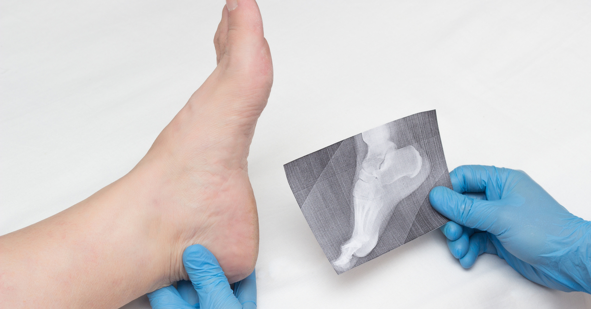 Treatment for Heel Spur with Insoles