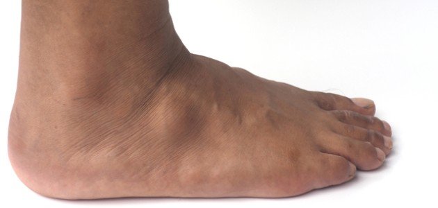 Treatment of Synovial Cyst in the Foot and How to Diagnose It!