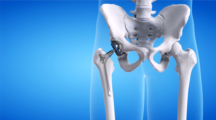 علاج وجع الفخذ وجراحة استبدال مفصل الفخذ 