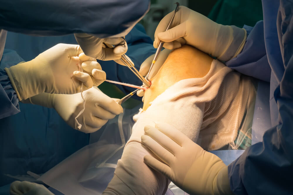 Cruciate Ligament Surgery