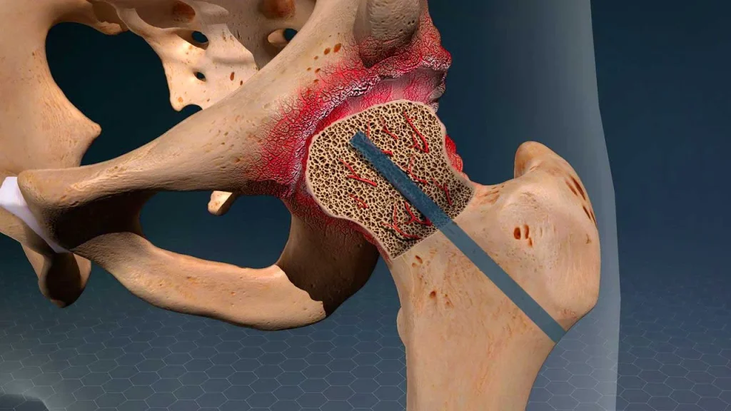 معلومات مميزة عن عملية تخريم عظمة الفخذ لمرور الدم