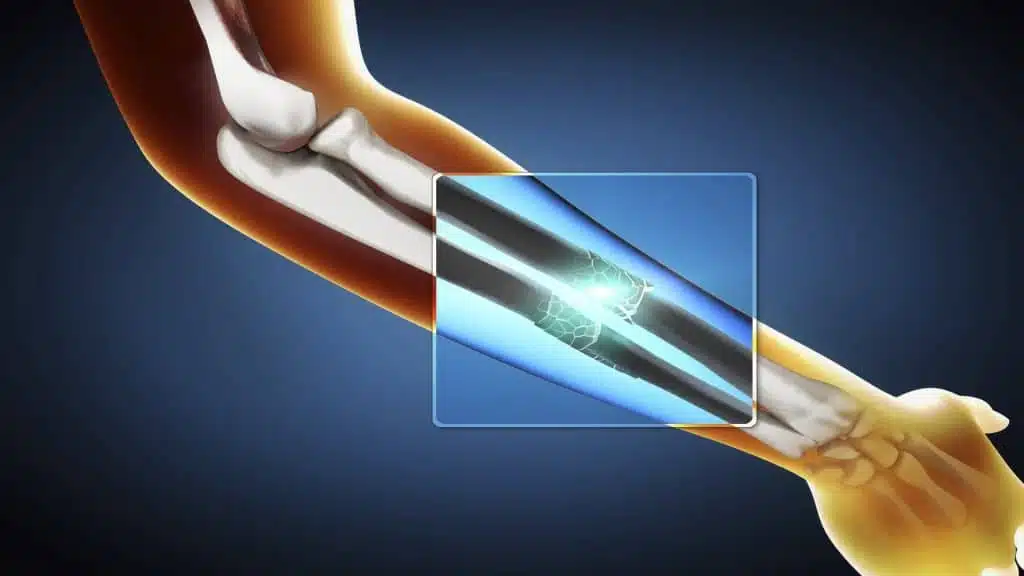 ?Plates and screws operation in the arm and how it can be used to treat fractures