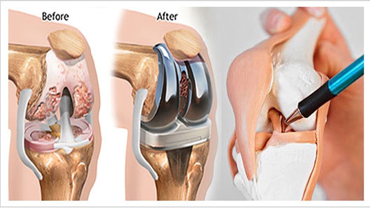 Joint replacement surgery and the cost of this procedure on the knee in Egypt