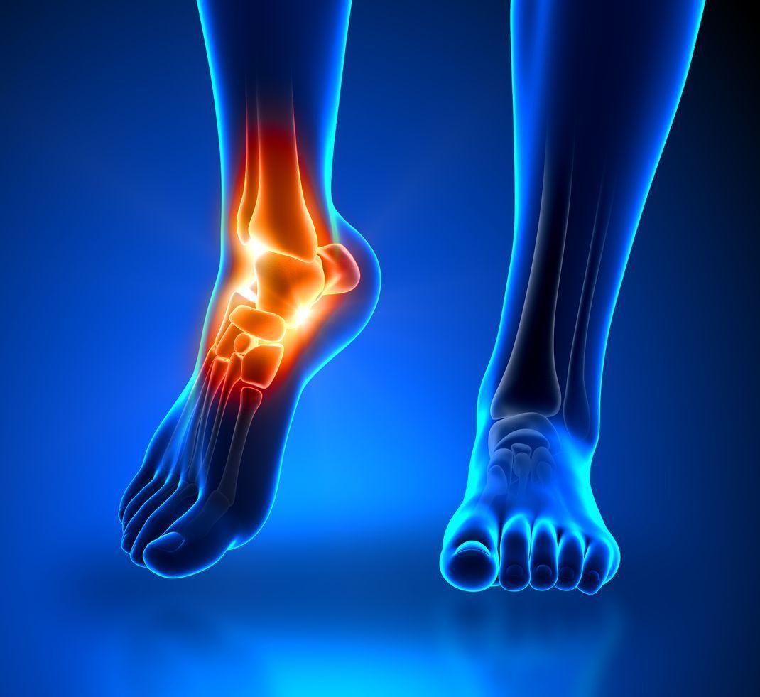 Information about Ankle Sprains and their Grades!