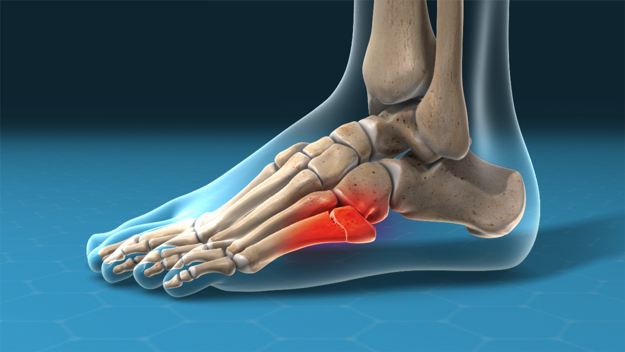 ! Foot Metatarsal Fractures and Their Most Important Types