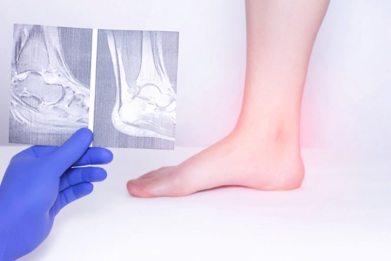 What is the Cost of Tendon Surgery?