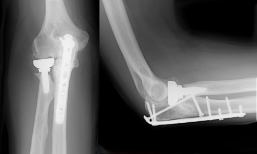 How to Install Plates and Screws to Stabilize and Treat Fractures