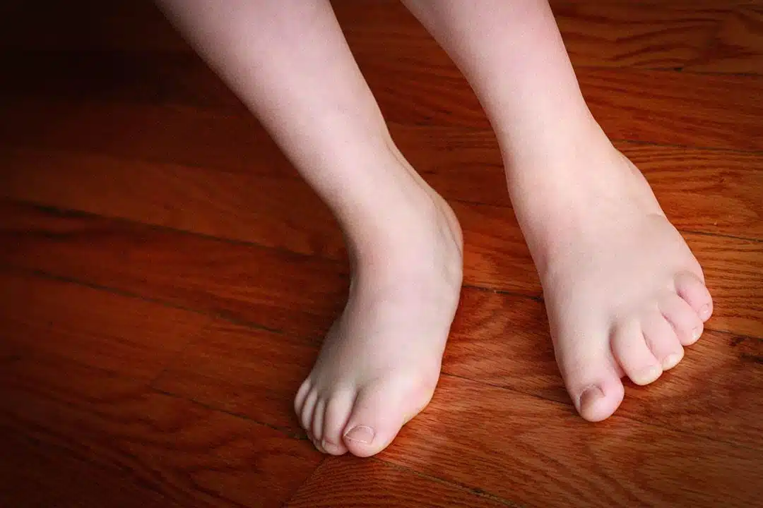 What is flat foot?