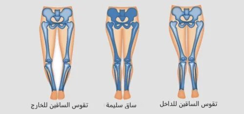 ما هو علاج تقوس الركبة للداخل؟