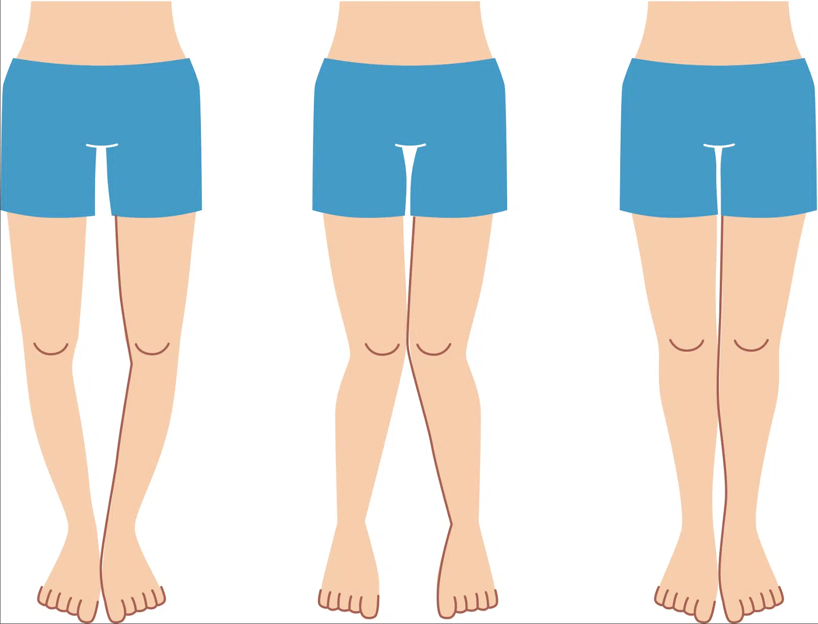 هل تقوس الساقين طبيعي؟