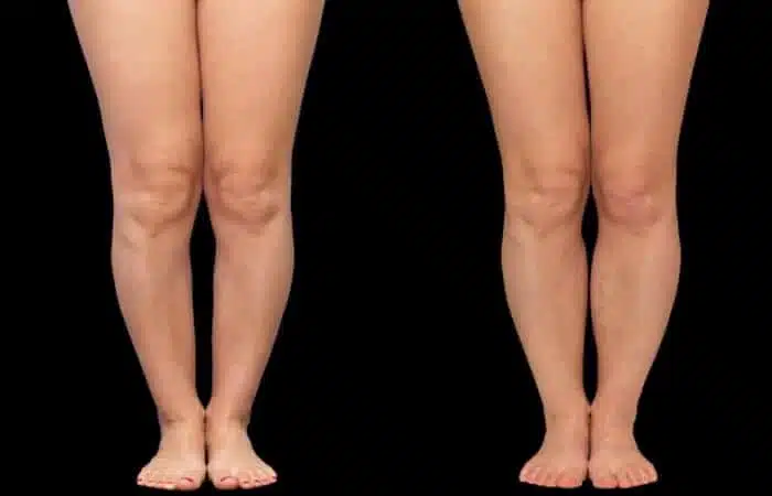 ما هي أهم الطرق العلاجية لتقوس الساقين؟