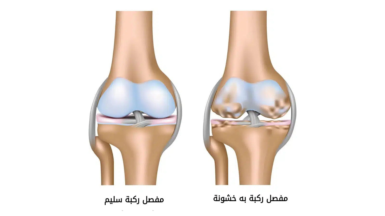 ما هو علاج نقص سائل الركبة بالأعشاب؟
