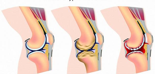 What is knee osteoarthritis