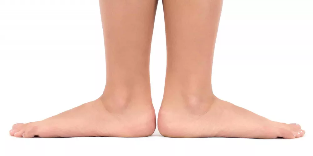 ?Flat foot treatment centers and what are the damages of its occurrence and the negligence in its treatment