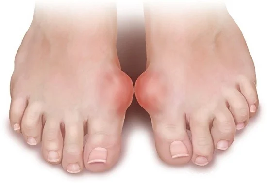 ?Gout and Its Main Symptoms in Women