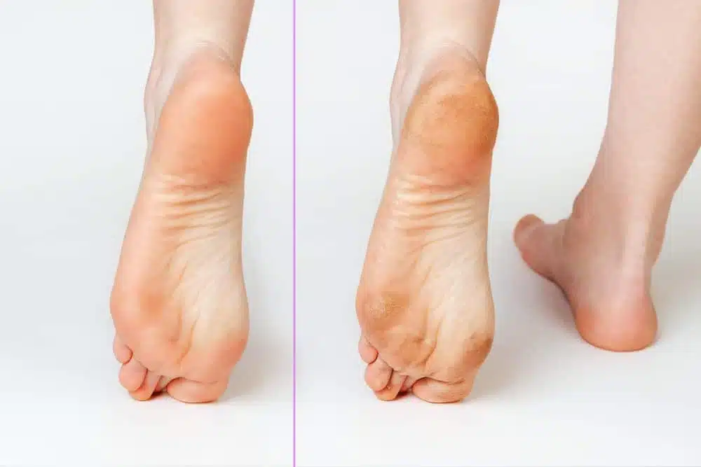 هل الفلات فوت يؤثر على المشى؟