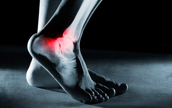 Does the Foot Return to Normal After a Fracture?