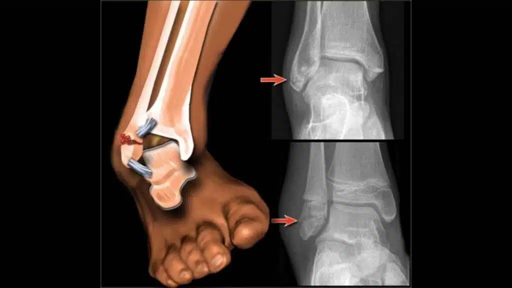 هل عملية الشرائح والمسامير صعبة؟