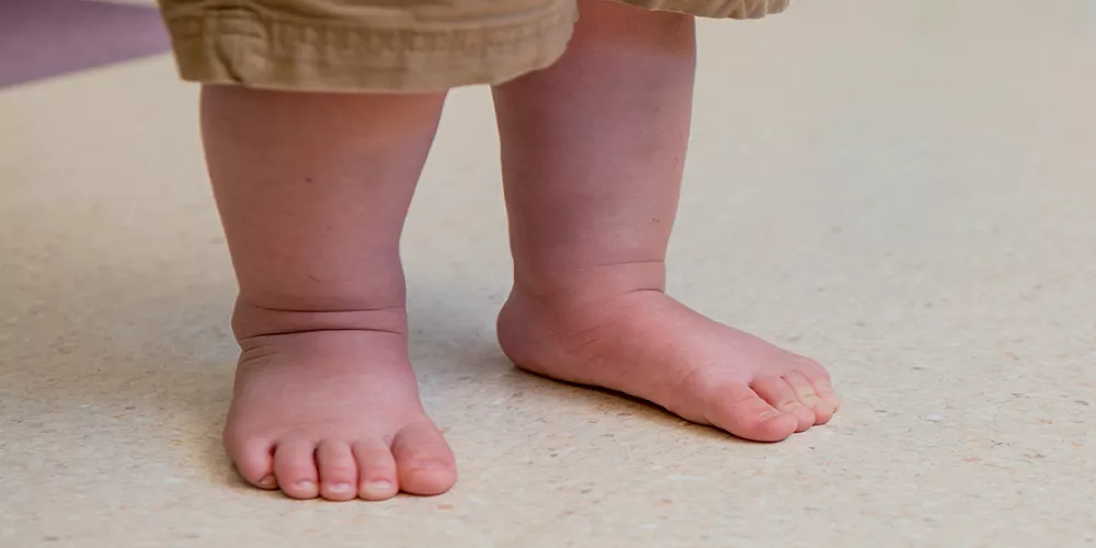 بروز عظمة القدم عند الأطفال