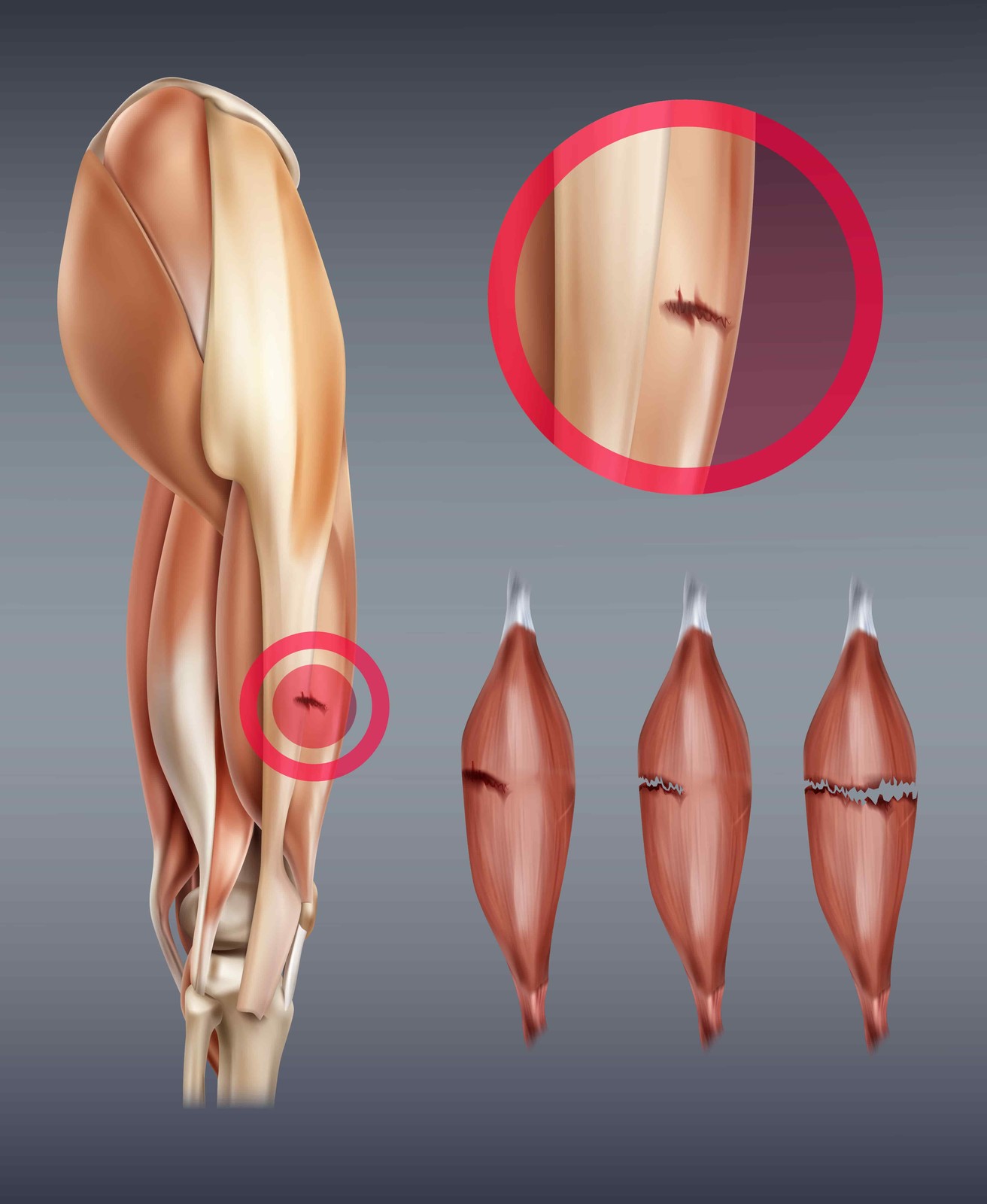 Learn About Grades of Hamstring Muscle Tears and Do Treatment Methods Differ for These Grades?