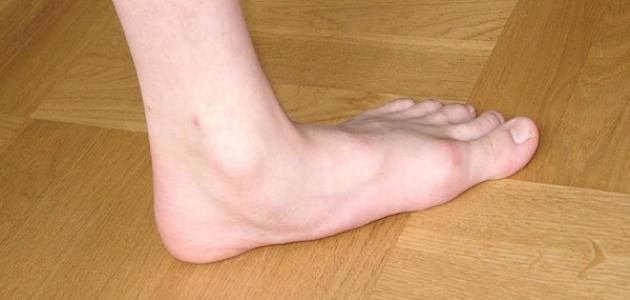 Treatment of Flat Feet in Adults