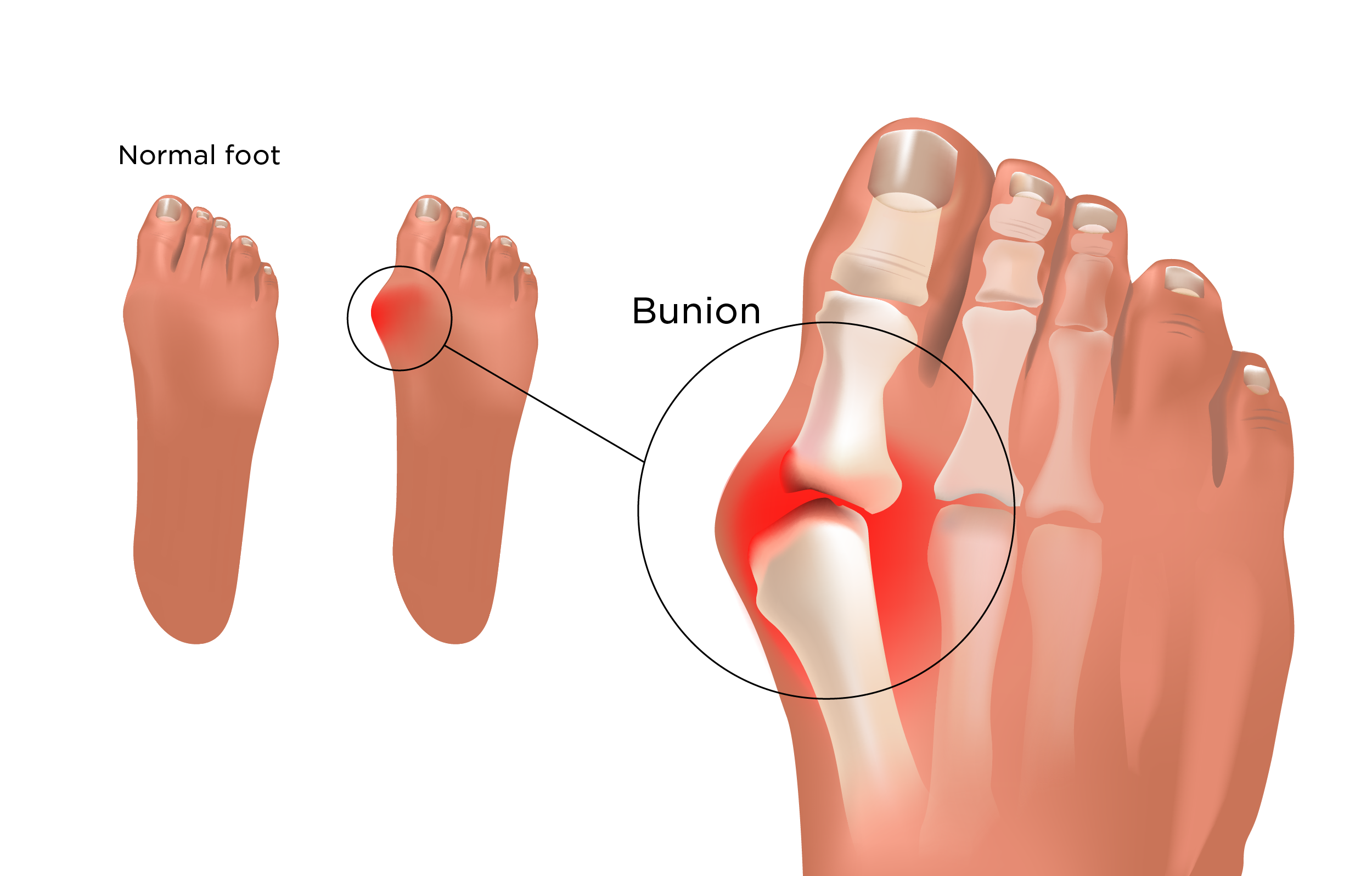 علاج بروز عظمة إصبع القدم الكبير