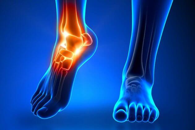 Discovering Foot Stress Fracture Treatment Without Plaster and Types of Fractures