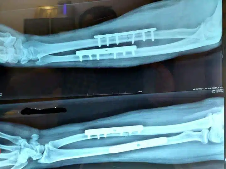 ما هي أسباب اللجوء إلى عملية الشرائح والمسامير؟