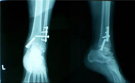 طرق تشخيص التئام العظام بشكل خاطئ