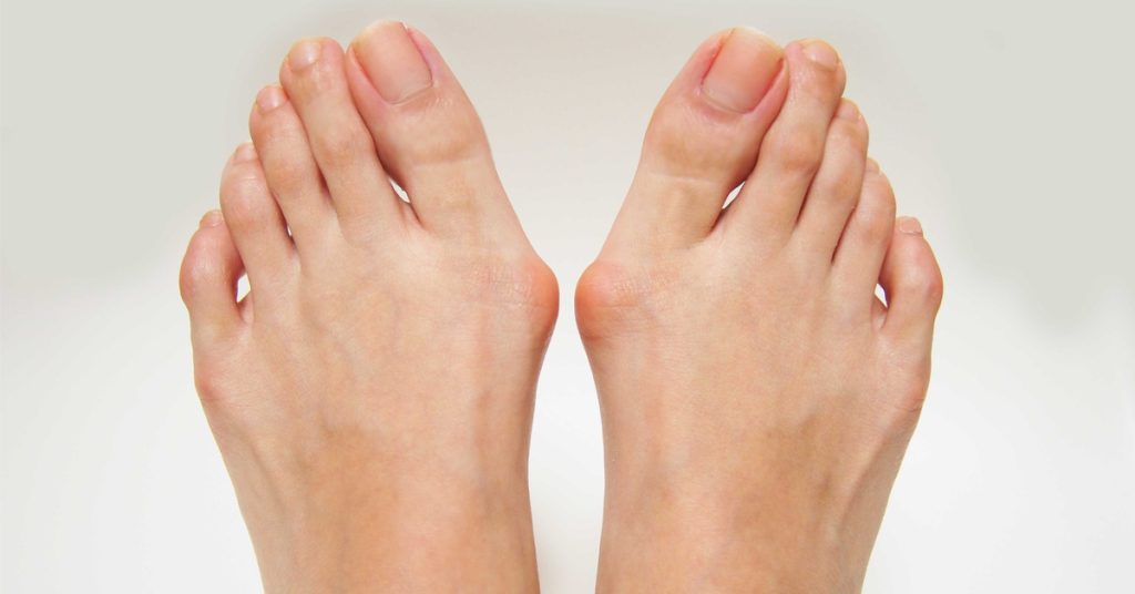 البروز العظمي في القدم: الأسباب وكيفية العلاج