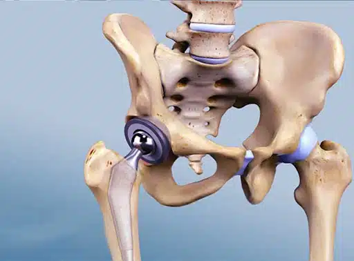 عملية تغيير مفصل الحوض