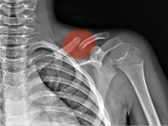 كسر عظام الترقوة