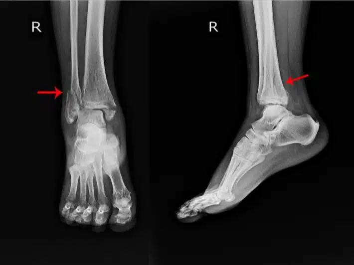 مضاعفات عدم التئام العظام