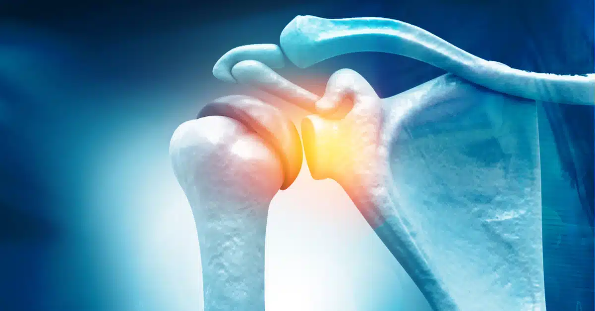 مزايا إجراء عملية تنظير مفصل الكتف