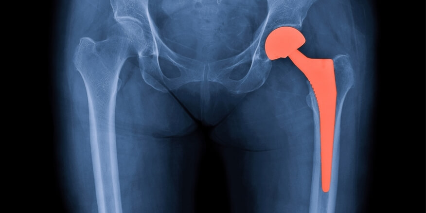 تنخر العظام: الأسباب والأعراض