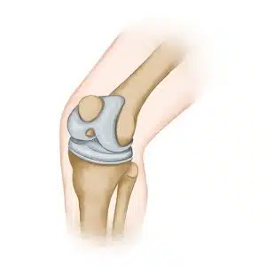 67039a9ea260b82f3a555cbb عملية تبديل مفصل الركبة