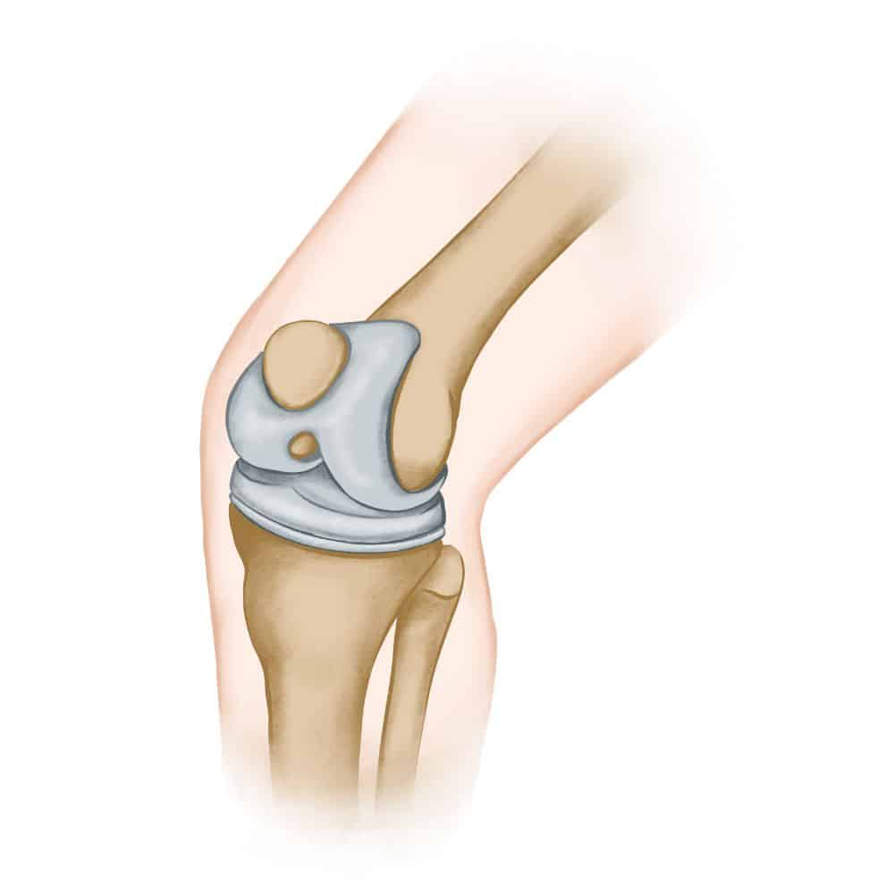 67039a9ea260b82f3a555cbb عملية تبديل مفصل الركبة