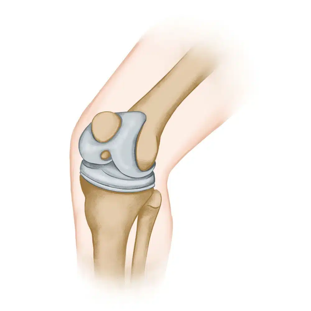 67039a9ea260b82f3a555cbb عملية تبديل مفصل الركبة