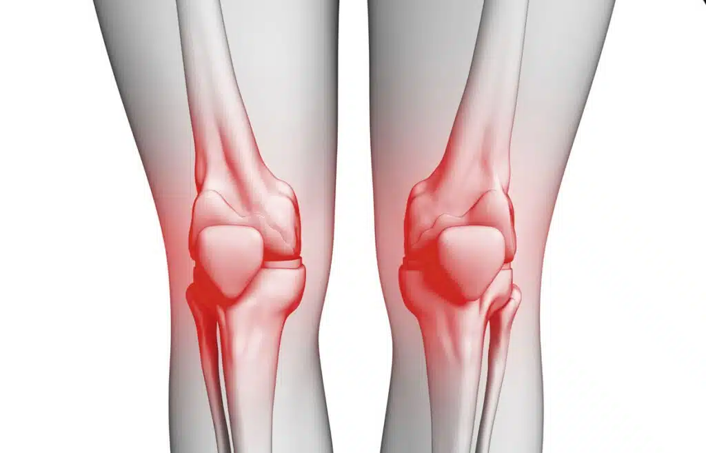 أسباب خشونة الركبة