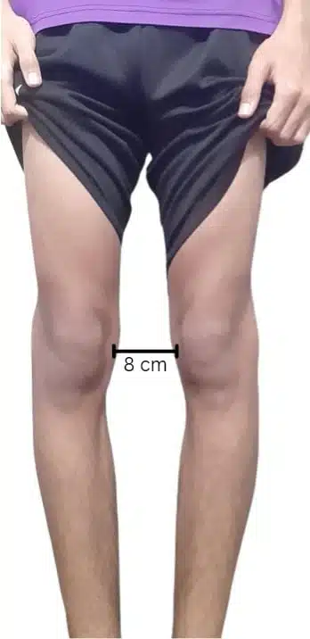 ما هي أسباب تقوس الساقين عند الكبار؟