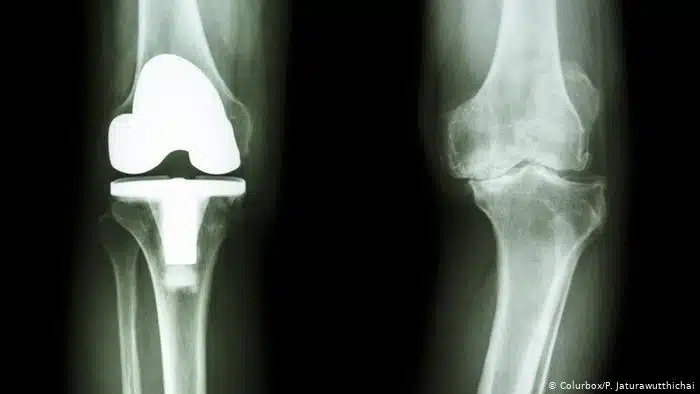 تكلفة عملية مفصل الركبة